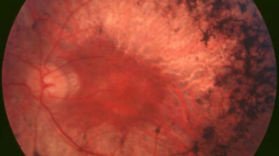 Fundus photograph of a retina affected by retinitis pigmentosa
