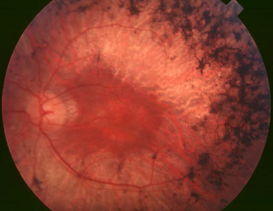 Fundus photograph of a retina affected by retinitis pigmentosa